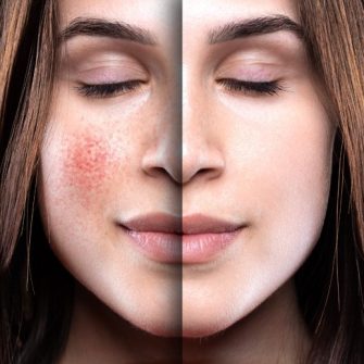 Rosacea kezelés