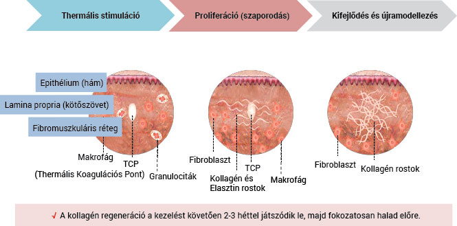 Kollagén újramodellezés