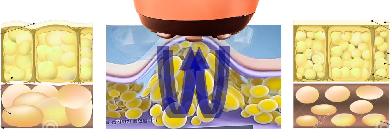 SOMA vákuum illusztráció